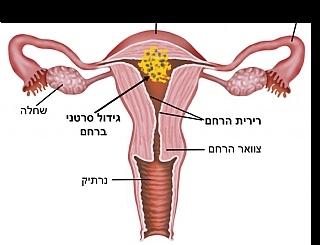 מחקרים פעילים ביחידה לגינקולוגיה אונקולוגית